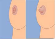 乳頭內(nèi)陷可以用吸奶器嗎？乳頭內(nèi)陷能不能用吸奶器？