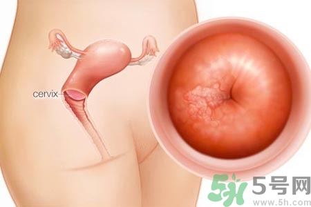 陰道松弛是什么？陰道松弛的癥狀有哪些？