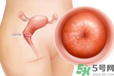 陰道出血和什么有關(guān)？陰道出血的應(yīng)急措施有哪些？