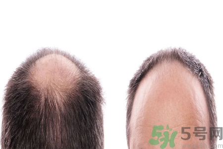 頭發(fā)稀少的原因是什么？如何預(yù)防禿頂?shù)陌l(fā)生？