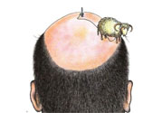 禿頂會遺傳嗎？治療禿頂?shù)姆椒ㄊ鞘裁矗?><p><strong>禿頂會遺傳嗎？治療禿頂?shù)姆椒ㄊ鞘裁矗?/strong></p></a></li> </ul>
</div>
<div   id=