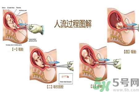 人工流產(chǎn)后多久可以再次懷孕？流產(chǎn)后需要注意什么？