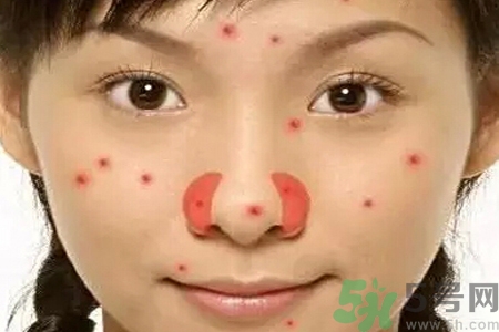 鼻翼長痘痘怎么回事？鼻翼長痘痘的原因是什么？
