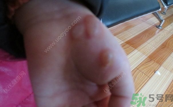 15歲還會(huì)得手足口病嗎？手足口病的癥狀有哪些？