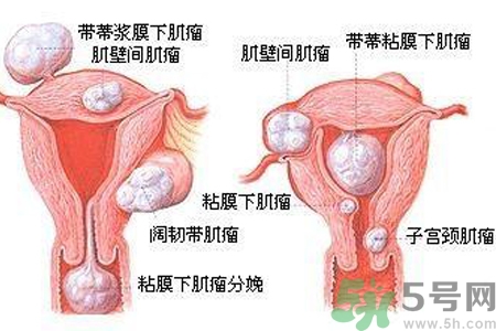 ?子宮移位怎么治療？子宮移位能懷孕嗎？