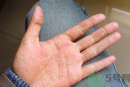 ?手掌脫皮的危害有哪些？如何預(yù)防手掌脫皮？