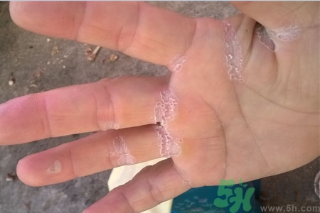 手脫皮是什么原因？手脫皮的治療方法是什么？