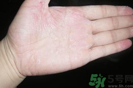 手脫皮是什么原因？手脫皮的治療方法是什么？