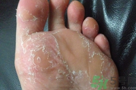 腳脫皮的治療方法有哪些？如何預防腳脫皮？