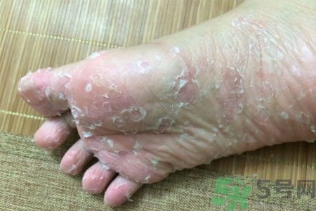 腳脫皮的治療方法有哪些？如何預防腳脫皮？