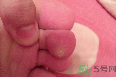 雞眼如何去除？腳上長(zhǎng)了雞眼怎么治療？