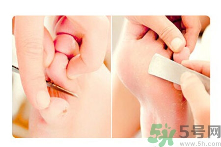 雞眼怎么能徹底根治？如何預(yù)防腳上長雞眼？