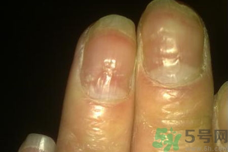 孩子手指甲凹凸不平是什么原因？手指甲凹凸不平的原因是什么？