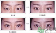 提眉術(shù)后多久可以恢復(fù)？提眉術(shù)后全過程照片