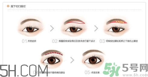 切眉手術(shù)后老得快嗎？切眉能保持多久？