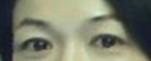 提眉術(shù)后多久可以恢復(fù)？提眉術(shù)后全過程照片