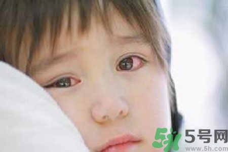 流行性腮腺炎的表現(xiàn)有哪些？?流行性腮腺炎飲食怎么調(diào)理？