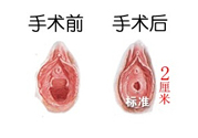 處女膜修補(bǔ)術(shù)效果怎么樣？處女膜修復(fù)手術(shù)有風(fēng)險(xiǎn)嗎？