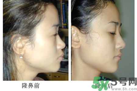 玻尿酸隆鼻的危害有哪些？玻尿酸隆鼻的副作用是什么？
