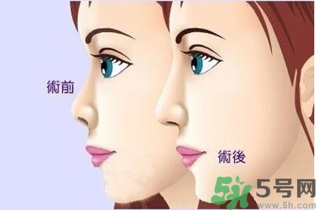 玻尿酸隆鼻的缺點是什么？玻尿酸隆鼻的優(yōu)點有哪些？