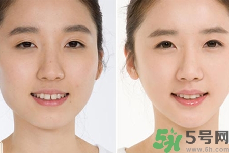 玻尿酸隆鼻的缺點是什么？玻尿酸隆鼻的優(yōu)點有哪些？