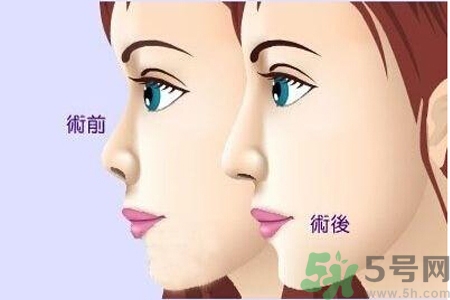 玻尿酸隆鼻和手術(shù)隆鼻的區(qū)別是什么？