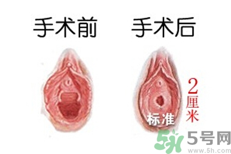 什么人不能做處女膜修補(bǔ)術(shù)？處女膜修補(bǔ)術(shù)會(huì)留疤嗎？