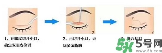 雙眼皮手術(shù)哪種最好？割雙眼皮后注意些什么？