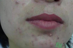 什么樣的痘痘能擠？哪些痘痘不能擠？