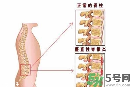僵直性脊椎炎的癥狀有哪些？怎樣預防僵直性脊椎炎？