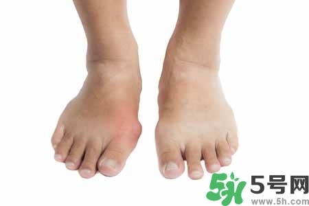 引發(fā)痛風的原因是什么？痛風病人飲食需注意什么好？