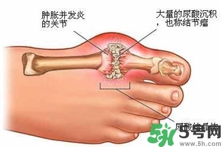 引發(fā)痛風的原因是什么？痛風病人飲食需注意什么好？