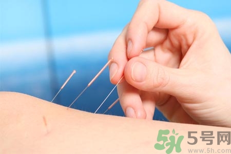 針灸一次要扎多長時間？針灸可以幾天做一次？