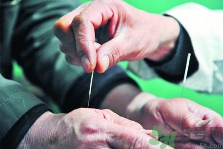 針灸一次要扎多長時間？針灸可以幾天做一次？