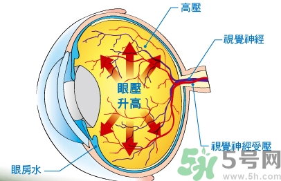 青光眼可以治愈嗎？青光眼怎樣治療？