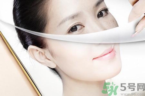 曬斑可以自己消退嗎？曬斑可以用激光去除嗎？