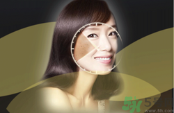 曬斑可以自己消退嗎？曬斑可以用激光去除嗎？