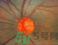 青光眼可以治愈嗎？青光眼怎樣治療？