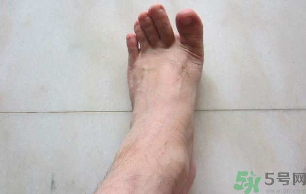 腳拇指外翻遺傳嗎？腳拇指外翻怎么矯正？
