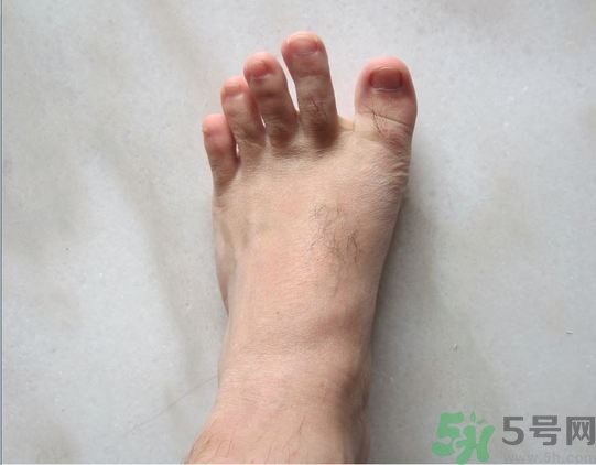腳拇指外翻遺傳嗎？腳拇指外翻怎么矯正？