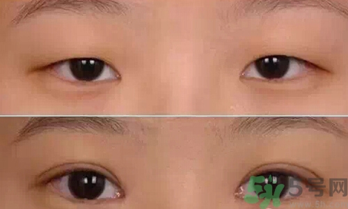 天生腫眼泡怎么消除？天生腫眼泡怎么辦？