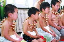 小孩可以拔罐嗎？寶寶能拔火罐嗎？