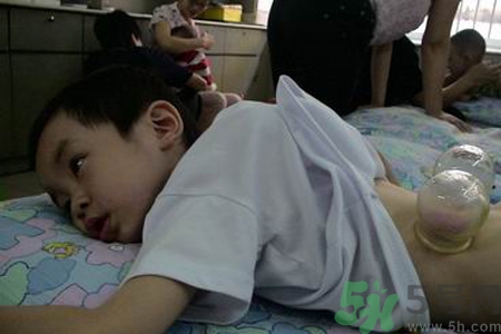 小孩可以拔罐嗎？寶寶能拔火罐嗎？