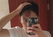 頭痛可以在額頭上拔火罐嗎？額頭上拔火罐有什么好處？