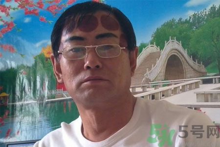 頭痛可以在額頭上拔火罐嗎？額頭上拔火罐有什么好處？