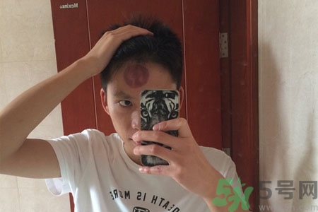 頭痛可以在額頭上拔火罐嗎？額頭上拔火罐有什么好處？