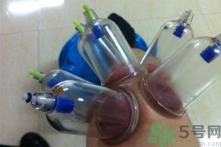 膝蓋能拔罐嗎？膝蓋疼可以拔罐嗎？