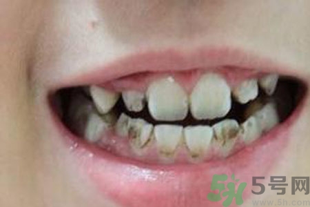 小孩牙齒發(fā)黑怎么回事？小孩牙齒發(fā)黑怎么辦？