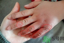 生凍瘡癢怎么辦？生凍瘡很癢的時候怎么辦？