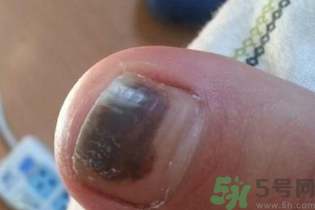 腳趾甲變黑是什么原因？腳趾甲變黑是怎么回事？